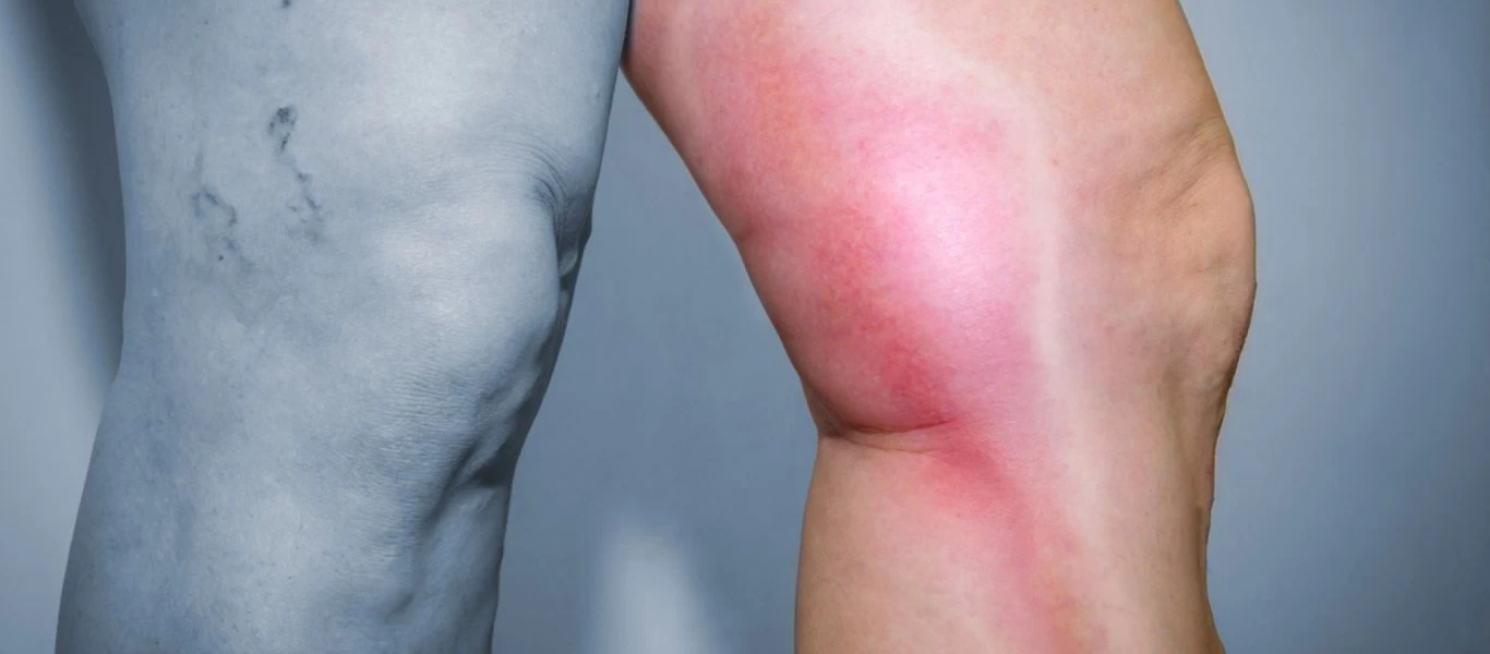 Θρόμβωση: Επτά «ύπουλα» συμπτώματα που πρέπει να γνωρίζετε